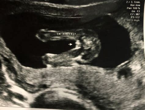 We see it all the time. . Ultrasound said girl but had a boy forum